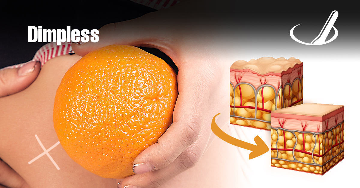 Dimpless - Alie-se a um agente de peso na luta contra a celulite!